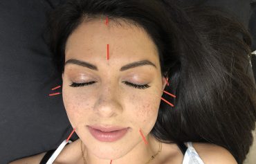 Cosmetic Acupuncture