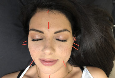 Cosmetic Acupuncture