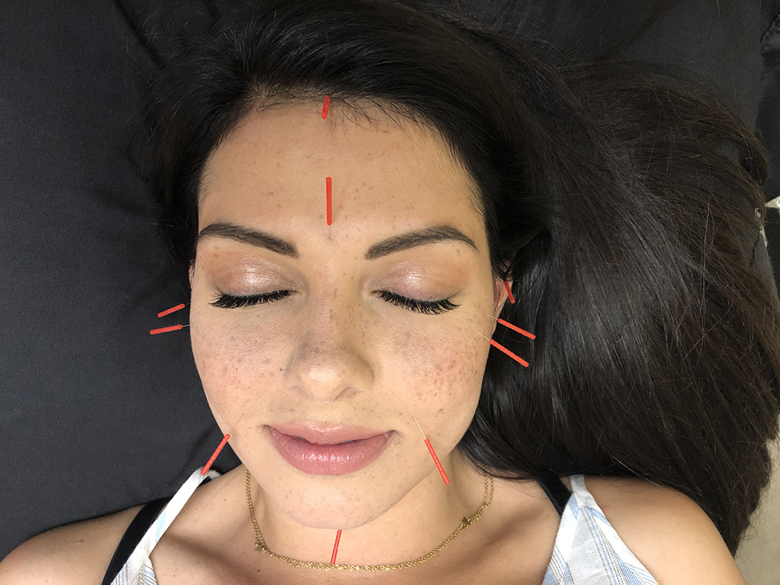 Cosmetic Acupuncture